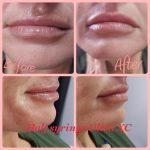 Photos of a woman's lips before and after dermal fillers.