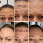 Photos of a woman's face before and after Botox.
